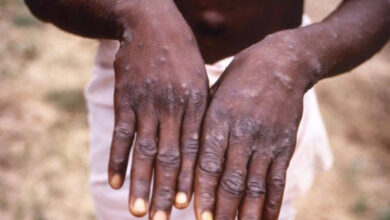 Ogun confirms 4 monkeypox cases